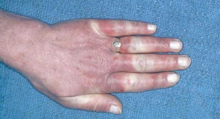 Obraz kliniczny zespołu Raynauda - skurcz naczyń, przekrwienie, obrzęk
